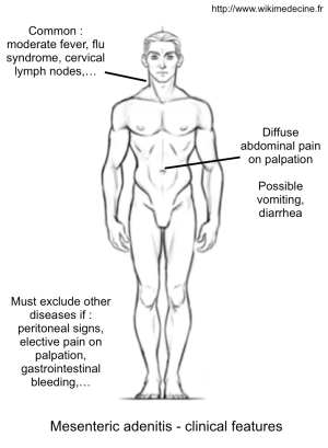 Mesenteric adenitis - clinical features