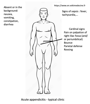 Acute appendicitis - typical clinic