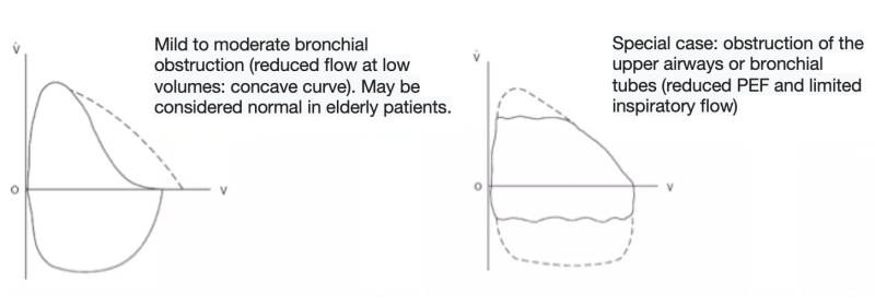 RFT - Flow-volume curves in an obstructive syndrome