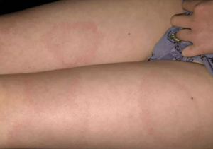 Lyme disease - Primary phase - Erythema migrans