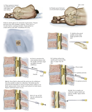 Lumbar puncture